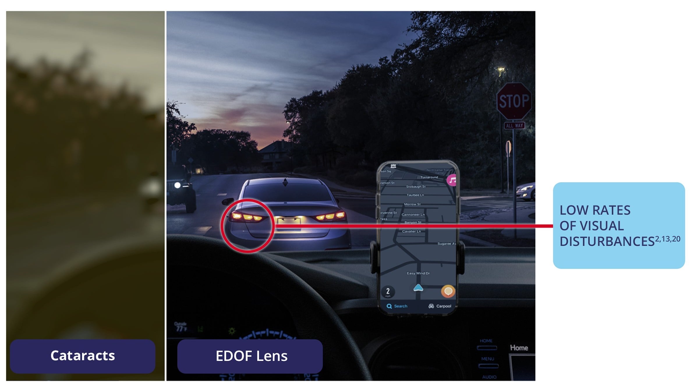 Side-by-side nighttime driving scene showing vision with cataracts compared to vision with an Extended Depth of Focus lens (EDOF IOL), highlighting clear distance vision, clear intermediate vision, and functional near vision with low visual disturbances