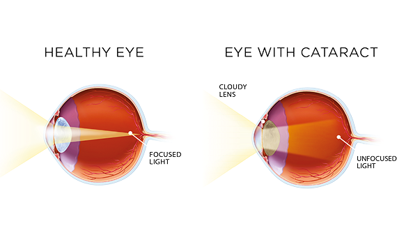 Diagram comparing a healthy eye with focused light to an eye with cataract showing a cloudy lens and unfocused light
