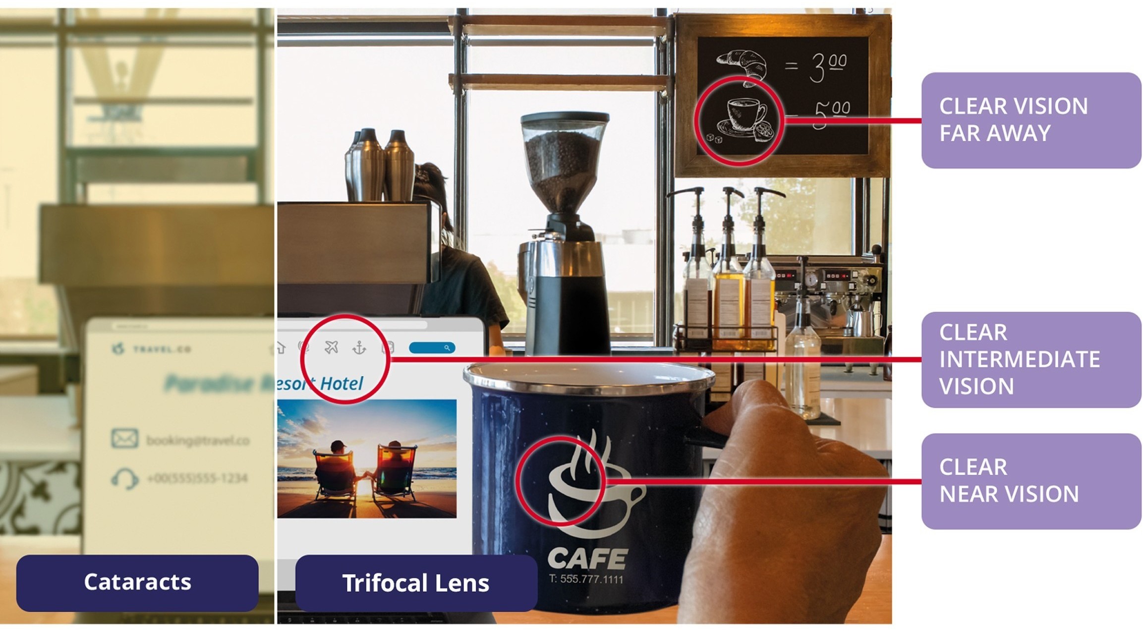Side-by-side café scene showing vision with cataracts compared to vision with a trifocal intraocular lens (IOL), highlighting clear distance vision, clear intermediate vision, and clear near vision with the lens
