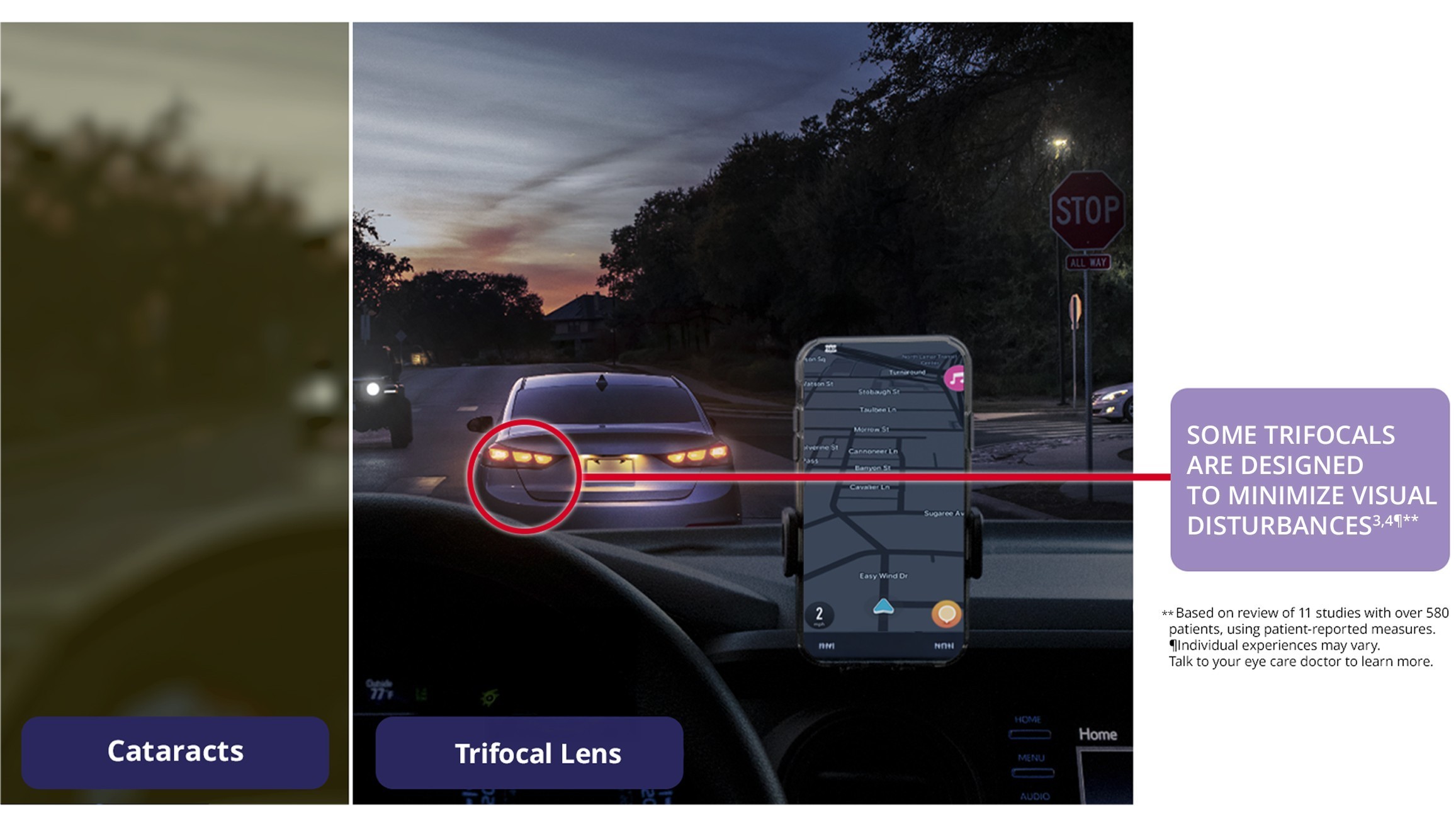 Side-by-side nighttime driving scene showing vision with cataracts compared to vision with a trifocal intraocular lens (IOL), highlighting clear distance vision, clear intermediate vision, and clear near vision with minimized visual disturbances
