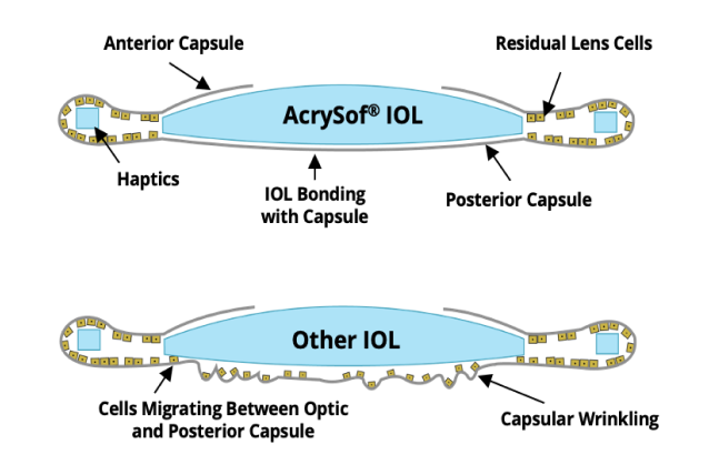 2 illustrations. The first one shows the AcrySof IOL bonded with the posterior capsul with not cell migration. The second illustration shows other IOLs with cells migrating between the optic and posterior capsule.