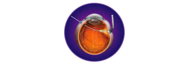 Illustration of a VEKTOR Laser probe going through an eyeball.