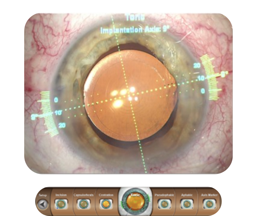 A close-up image of an eye with a digital overlay from VERION™ showing the toric implantation axis