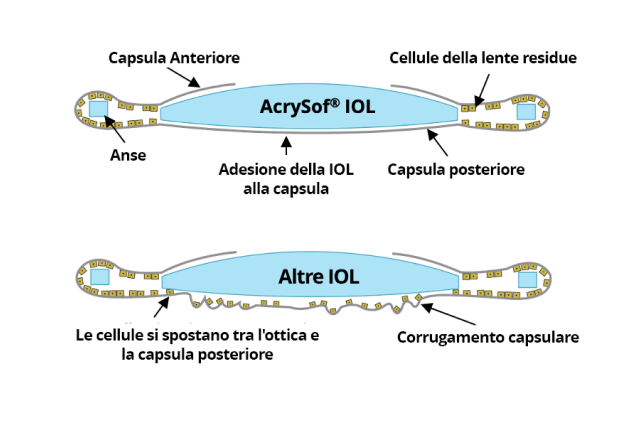 2 illustrazioni. La prima mostra la IOL AcrySof legata alla capsula posteriore senza migrazione cellulare. La seconda illustrazione mostra altre IOL con cellule che migrano tra la capsula ottica e quella posteriore.