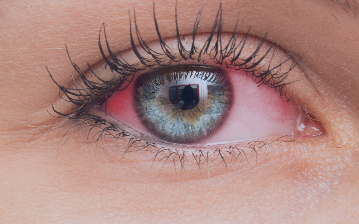 Close-up on blue reddened eye