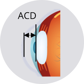 Illustrazione di un occhio con indicazione della profondità della camera anteriore (ACD) tramite una doppia freccia nera.