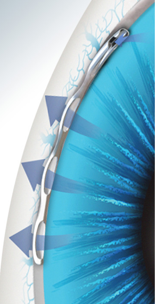 A close-up image of the Hydrus Microstent implanted in an eye. Blue arrows travelling outwards indicate flow travelling through the device to relieve intraocular pressure.