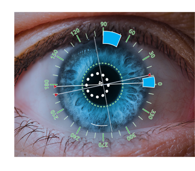 眼球のクローズアップ画像に、角度と切開位置をデジタルオーバーレイで表示したもの