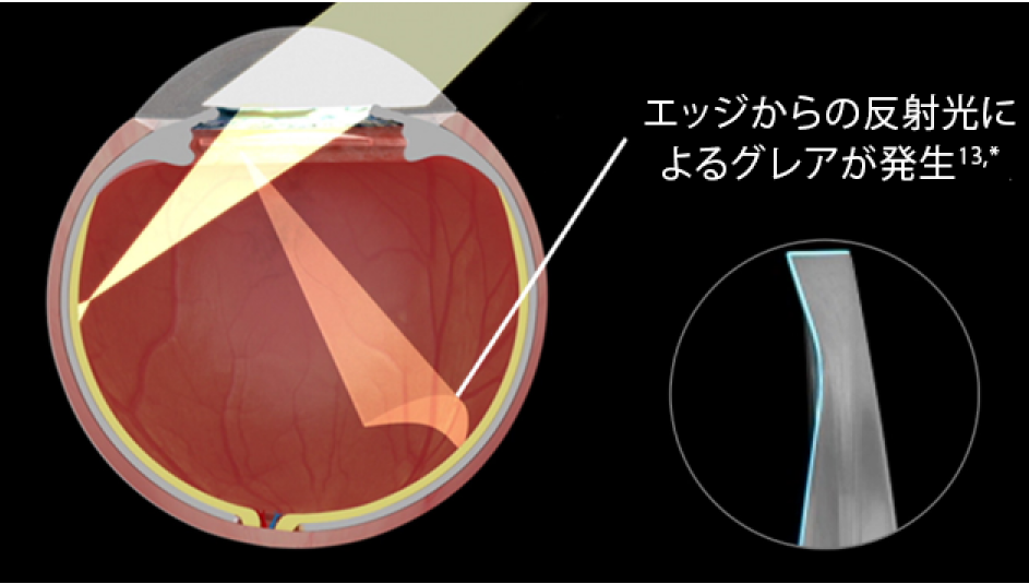 黒い背景のストレートエッジの眼内レンズを挿入した眼の断面画像。光が目に入るとグレアが著しく増加することがわかるin vitroの画像。右の円形の画像は、精密なデザインのストレートエッジ眼内レンズを強調する画像。