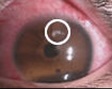 Close-up of a human eye with corneal infiltration