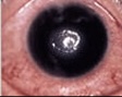 Close-up of an eye with acute corneal epithelial edema