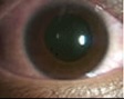 Close-up of an eye with allergic conjunctivitis