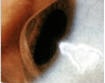 Close-up of an eye with keratoconus