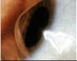 Close-up of an eye with keratoconus