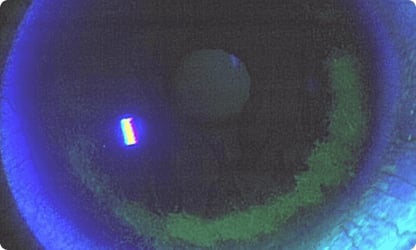 Corneal epithelial damage