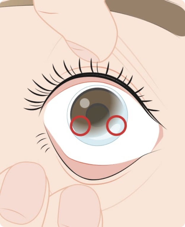 Correct place to pinch a contact lens when removing it from the eye