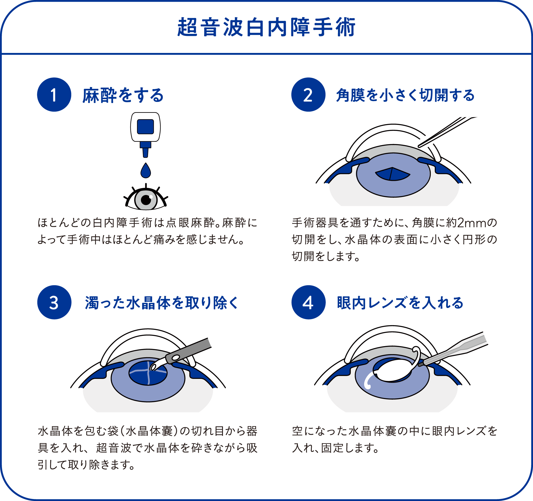 超音波白内障手術の段取りを説明する図。麻酔をする。角膜を小さく切開する。濁った水晶を取り除く。眼内レンズを入れる。