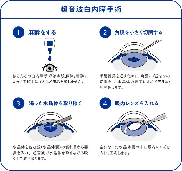超音波白内障手術の段取りを説明する図。麻酔をする。角膜を小さく切開する。濁った水晶を取り除く。眼内レンズを入れる。