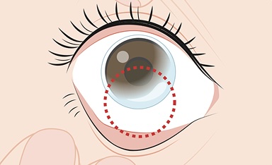 Position of the contact lens on the eye during removal