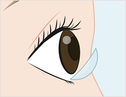 Side view of an eye during contact lens insertion