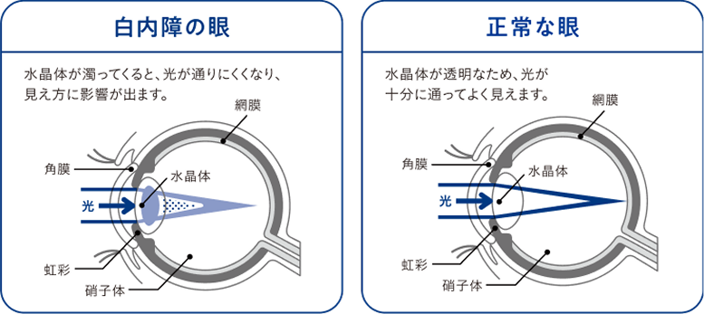 白内障の眼と正常な眼の比較対象図。水晶体が濁ってくると、光が通りにくくなり、見え方に影響が出ます。正常な眼の場合、水晶体が透明なため、光が十分に通ってよく見えます。