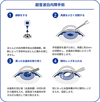 超音波白内障手術の4つの手順を説明する図。1. 麻酔をする（ほとんどは点眼麻酔）。2. 角膜を約2mm小さく切開する。3. 超音波で濁った水晶体を砕きながら吸引して取り除く。4. 空になった水晶体嚢に眼内レンズを入れて固定する。