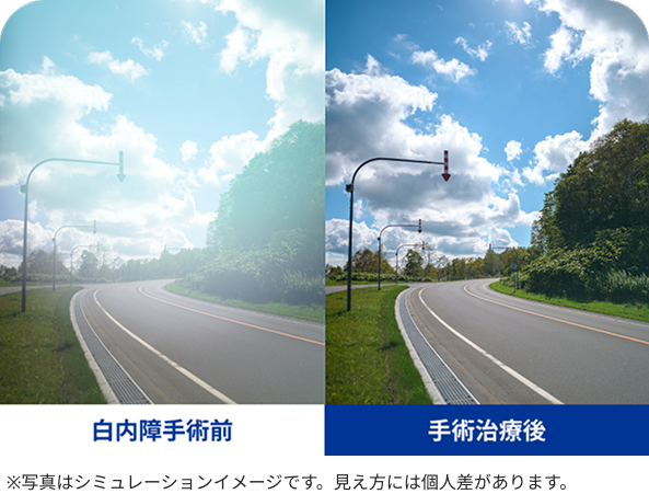 白内障手術前と手術治療後の見え方。道路と木と雲の風景