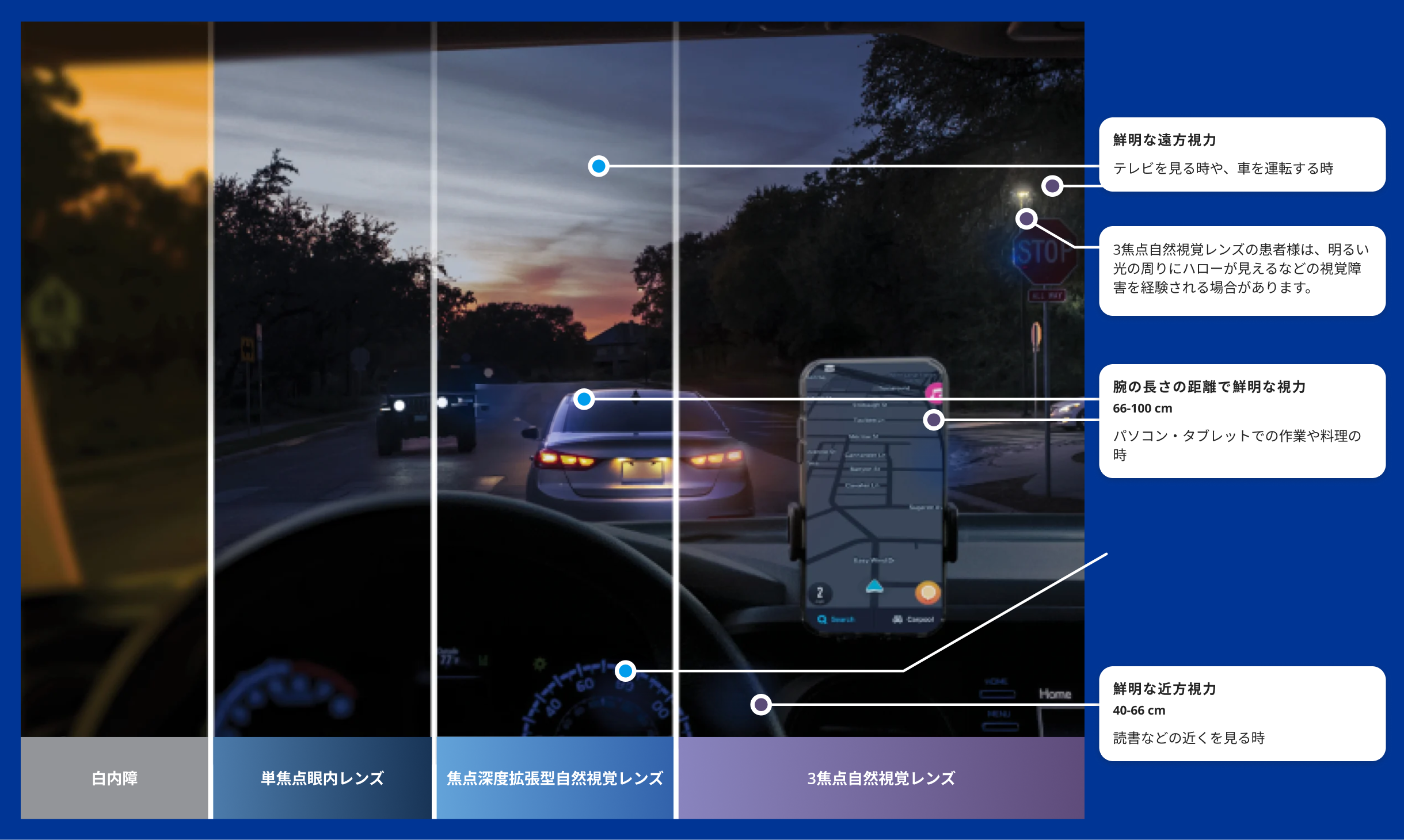 薄暗い道を走る車の中のドライバーの視界を表した写真。ダッシュボードにはナビゲーションアプリが表示された携帯電話が取り付けられています。  白内障の見え方と、単焦点レンズ、拡張視野レンズ、3焦点レンズの見え方の違いを、4分割で表現しています。画像の左端は、白内障による視力の低下を表すため、黄色くぼやけています。残りの3カ所は、白内障の治療に眼内レンズを使用した場合の視覚的なメリットを示すために、非常に鮮明になっています。