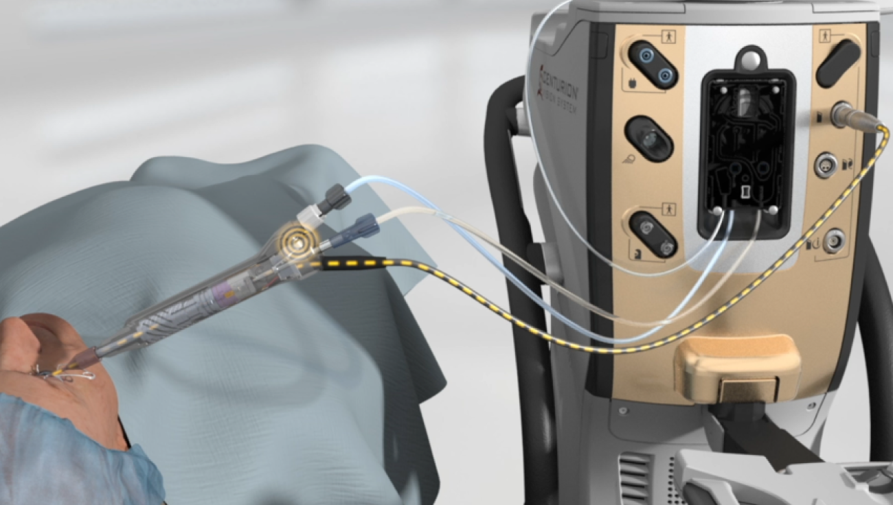 수술 중인 환자 옆에 CENTURION Vision System과 ACTIVE SENTRY handpiece의 애니메이션 영상. 노란색 점선은 ACTIVE SENTRY Handpiece 내부에 위치한 Irrigation Pressure Sensor를 강조합니다.
