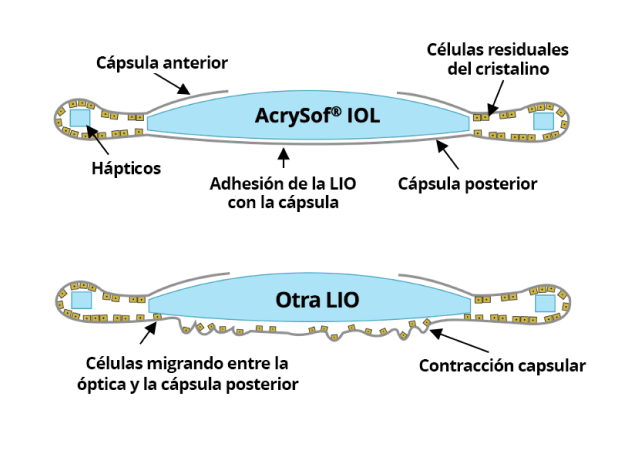 2 ilustraciones. La primera muestra la LIO AcrySof unida con la cápsula posterior sin migración de células. La segunda ilustración muestra otras LIOs con células migrando entre la óptica y la cápsula posterior.