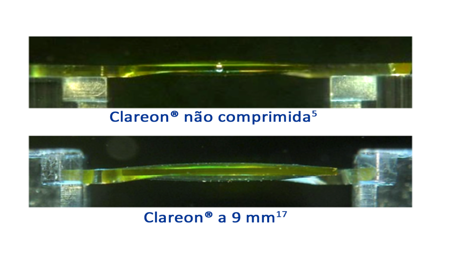 Uma imagem lateral da LIO Clareon, ilustrando a forma da LIO quando descomprimida. Uma imagem lateral da LIO Clareon, ilustrando a forma da LIO com 9 mm de compressão.
