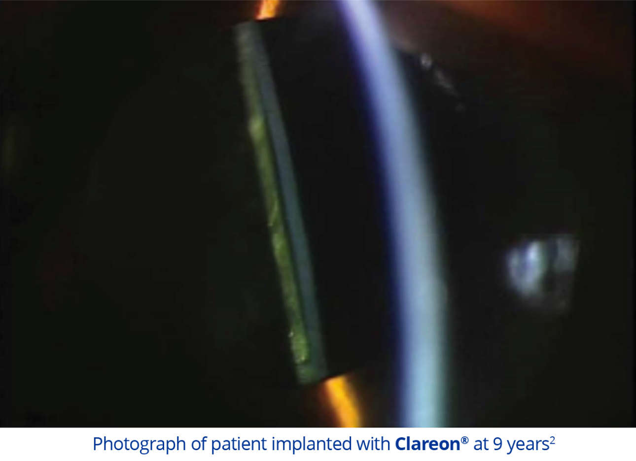 Această imagine este o fotografie a ochiului unui pacient la 9 ani după implantarea unui cristalin artificial Clareon.