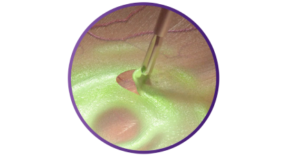 Close up of the SHARKSKIN ILM forceps grasping tissue to demonstrate its peeling ability.