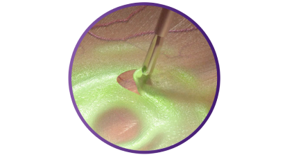 Close up of the SHARKSKIN ILM forceps grasping tissue to demonstrate its peeling ability.