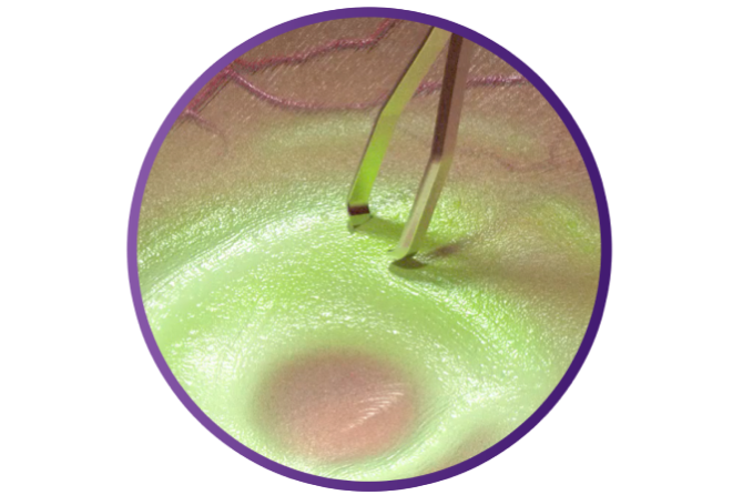 Close up of the SHARKSKIN ILM forceps grasping tissue to demonstrate its peeling ability.