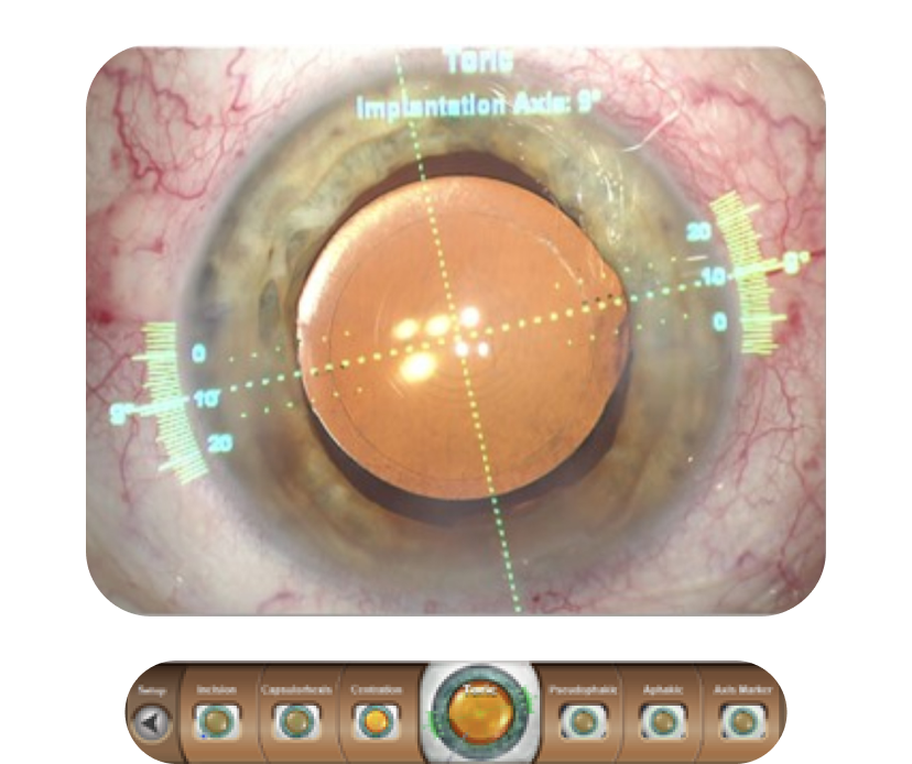 A close-up image of an eye with a digital overlay from VERION™ showing the toric implantation axis.