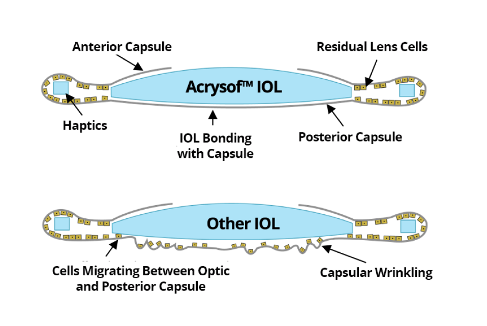 2 illustrations. The first one shows the AcrySof IOL bonded with the posterior capsul with not cell migration. The second illustration shows other IOLs with cells migrating between the optic and posterior capsule.