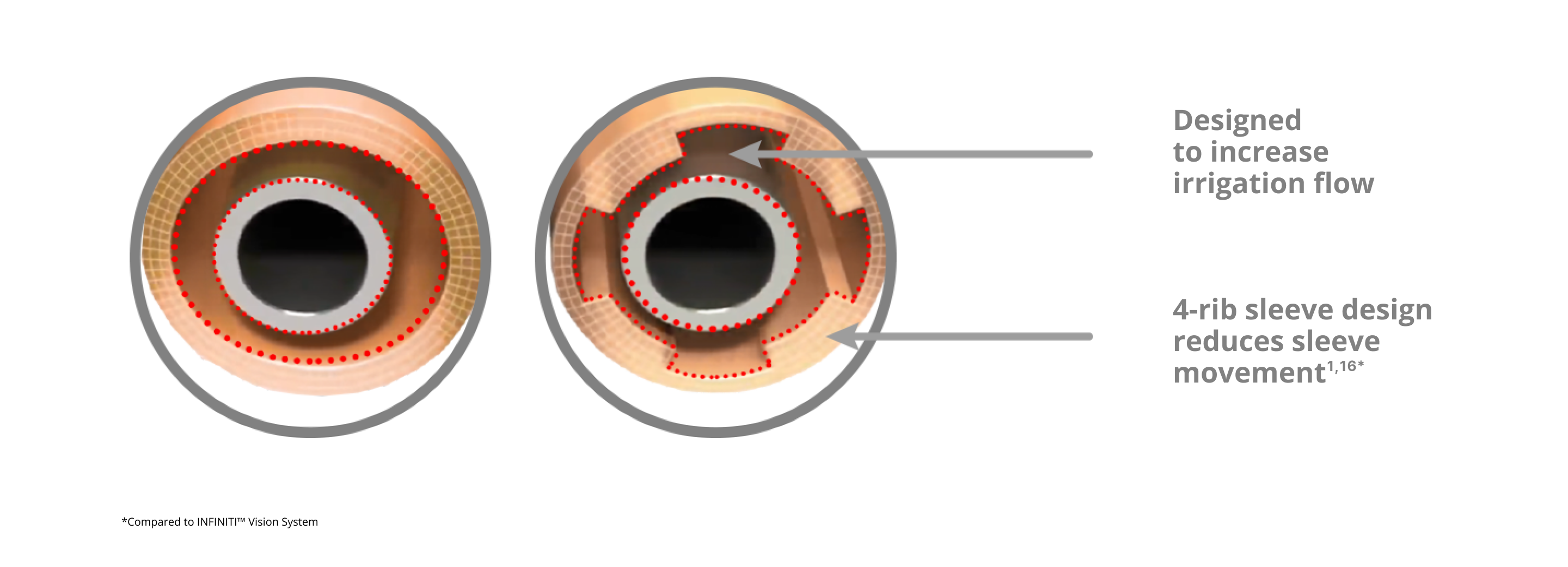 An image of that showcases the INTREPID irrigation sleeve with a 4-rib sleeve design which reduces sleeve movement and increases irrigation flow compared to the INFINITI Vision System