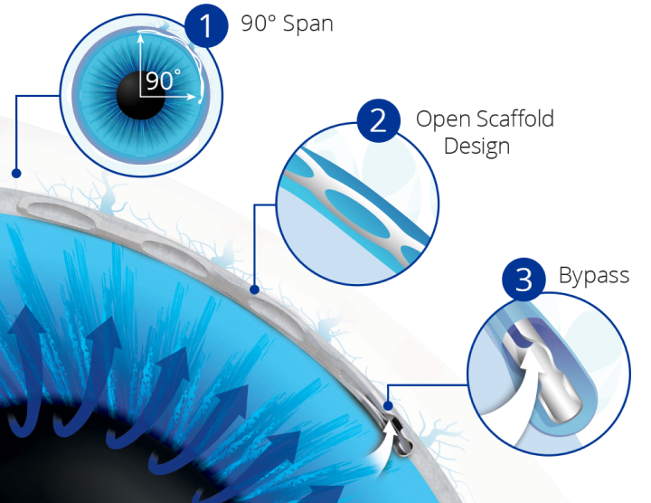 An up-close image of the Hydrus Microstent implanted in an eye. Dark blue arrows indicate flow travelling through the device. Three circular images numbered one through three point to various locations on the device in the eye. The magnified image in number one indicates a 90º Span, number two indicates Open Scaffold Design, and number three indicates Bypass.