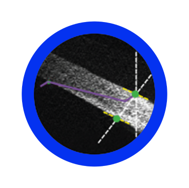 More accurate, more efficient, and less damaging self-sealing cataract incision in terms of architecture, size and geometry6