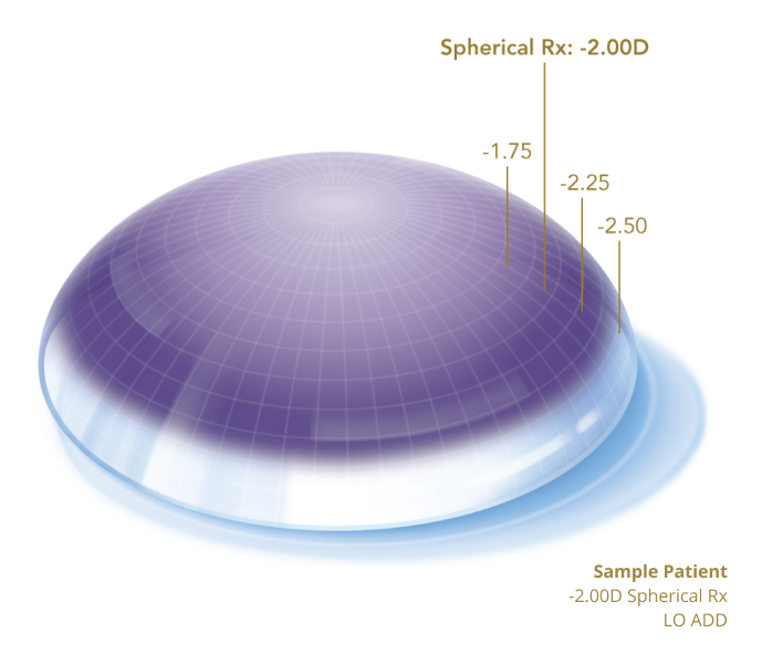 Profile view of sample patient's eye showing a Spherical Rx of -2.00D and LO ADD