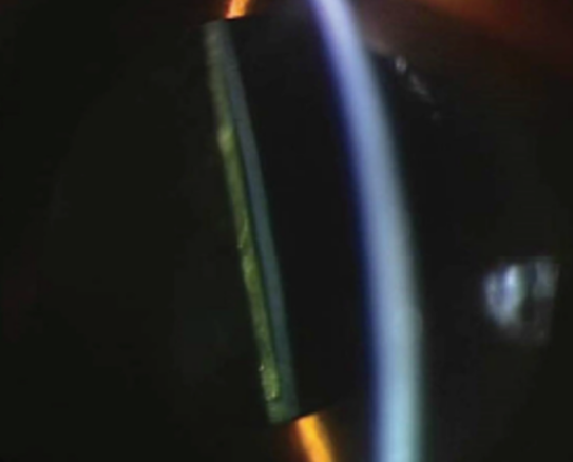 Photograph of patient implanted with Clareon® at 9 years shows Clareon® remains glistening- and light-scatter free*