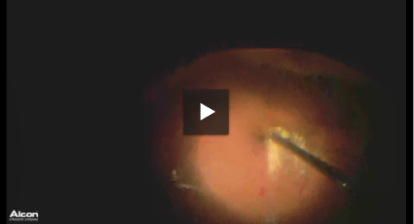 Diabetic Tractional Retinal Detachment Video Link