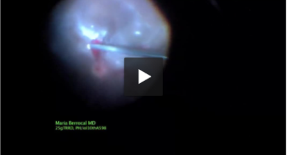 Segmentation and peeling with Advanced ULTRAVIT® beveled high speed probe video link