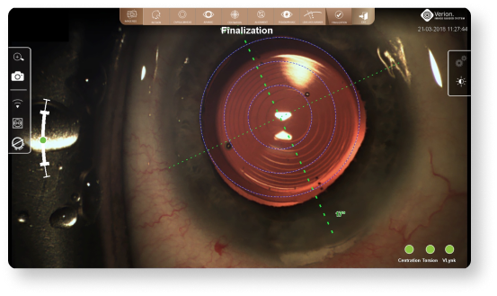 An image of the final IOL position is captured and stored for future reference12