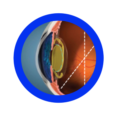 Less variability of anterior chamber depth with more stable post-op refraction7