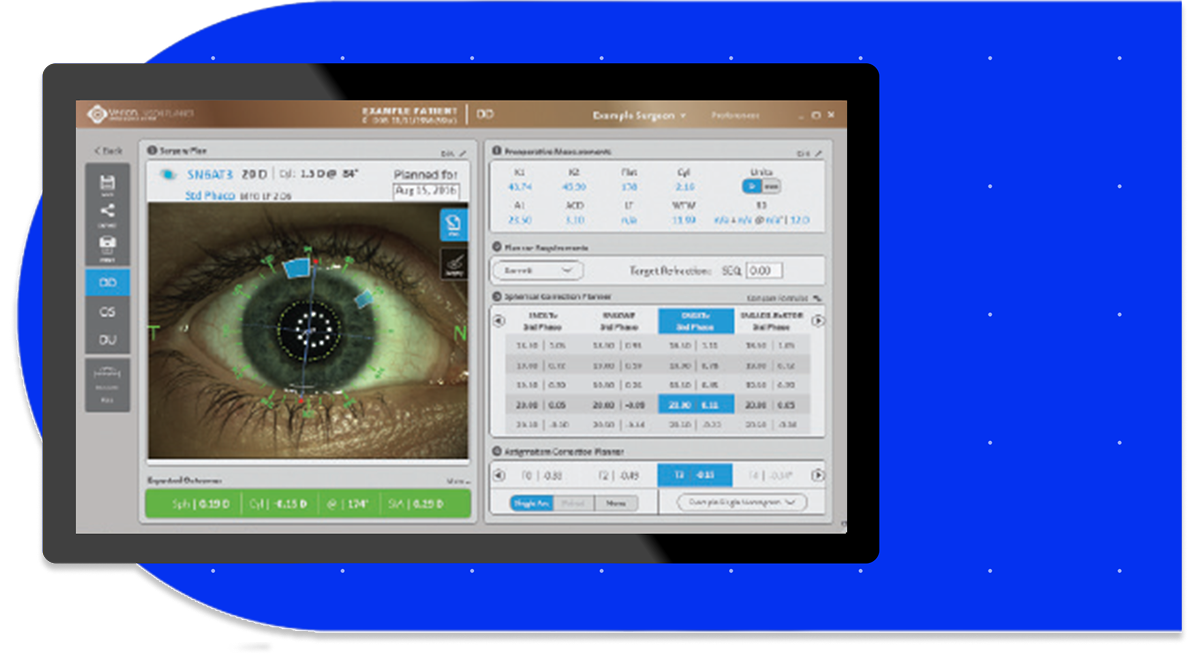 Digital surgical planning screen showing a close-up of a patient’s eye with overlays for astigmatism correction and cataract surgery parameters