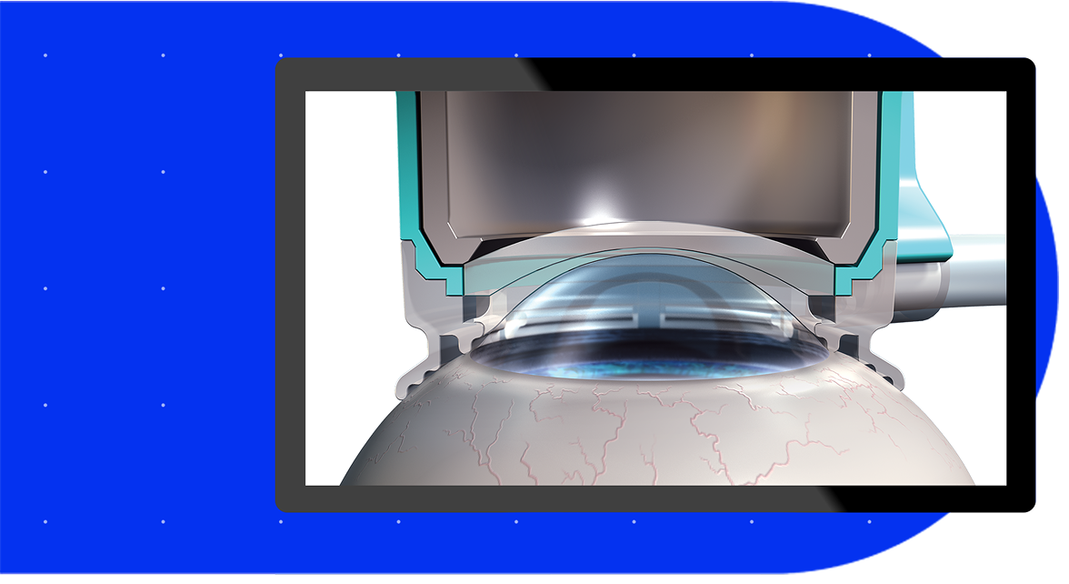 Illustration of a femtosecond laser system applying suction and alignment to the cornea during cataract surgery
