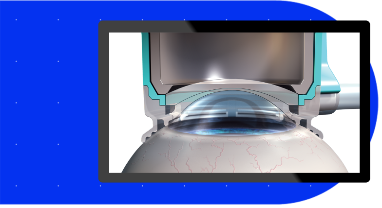 The SoftFit® Patient Interface –Experience greater precision
with the hydrogel lens insert of
the LenSx® Laser.