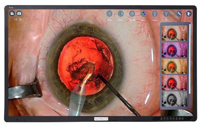 Intraoperative view of an eye during cataract surgery, showing a red-illuminated pupil with surgical instruments inside the anterior chamber and a live digital surgical interface displaying multiple filtered views along the right side of the screen.
